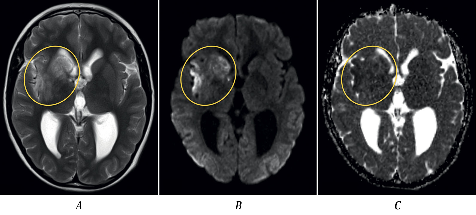 Ischemic Stroke in MCA Dissection with the Formation of the Double Lumen: Diagnostic Challenges ...