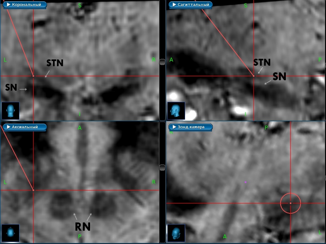 Bilateral stimulation of the subthalamic nucleus under local and general  anaesthesia - Asriyants - Annals of Clinical and Experimental Neurology